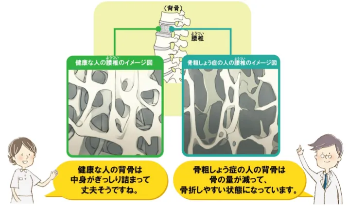 骨粗鬆症の写真