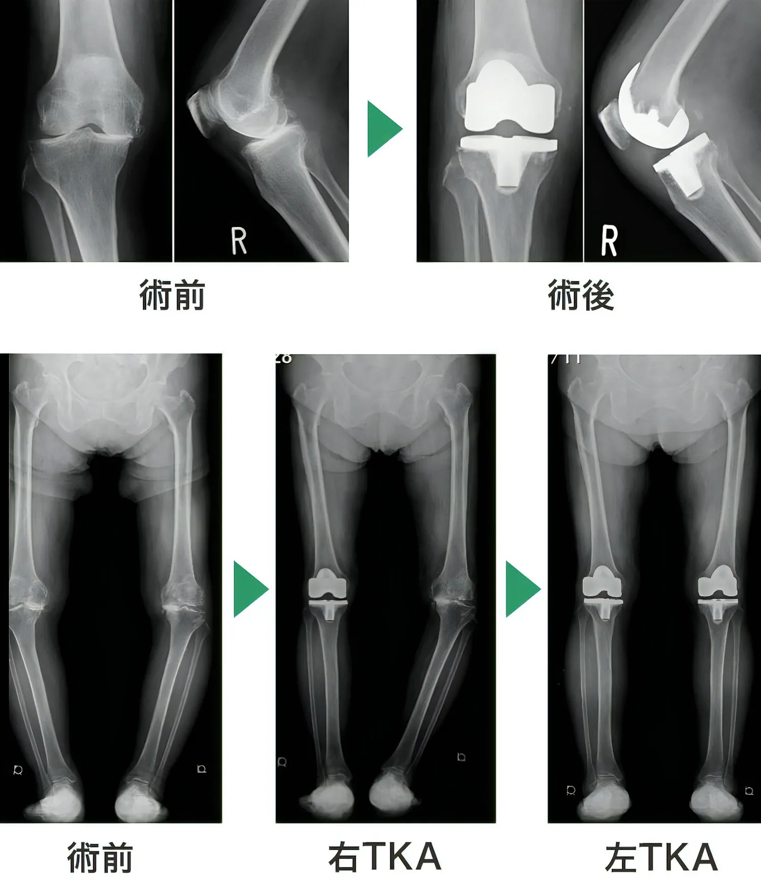 TKAの写真