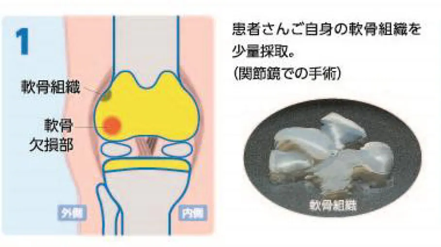 自家培養軟骨移植術の写真