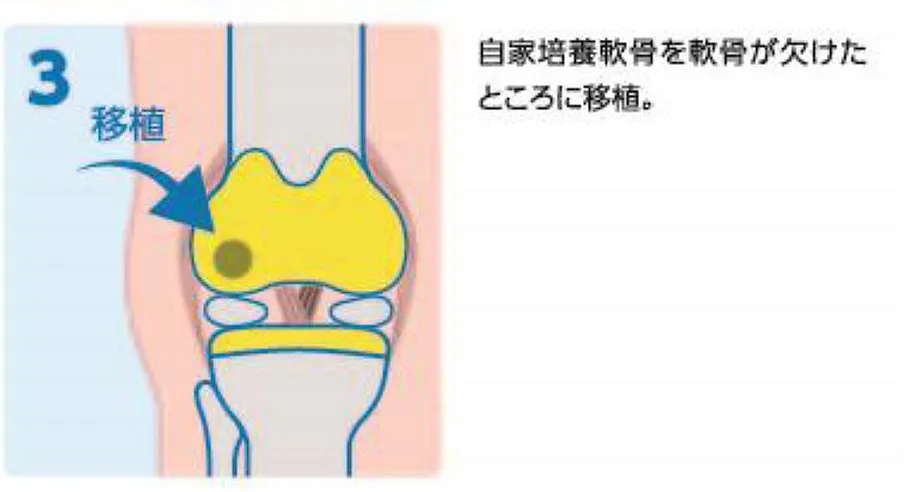 自家培養軟骨移植術の写真