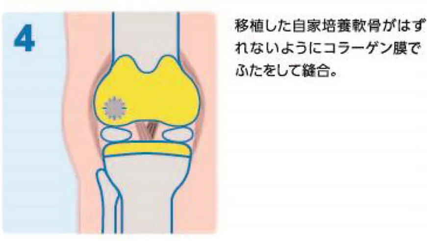 自家培養軟骨移植術の写真