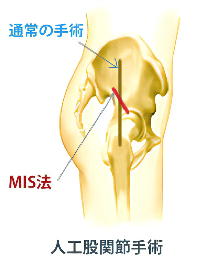 MIS(最小侵襲人工関節手術)の写真