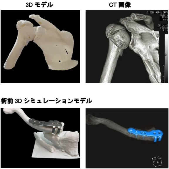 立体骨モデルの作成例の写真